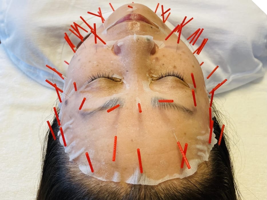 美容鍼灸の施術を受ける若い女性